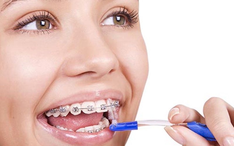 Sau khi niềng răng bạn phải biết cách chăm sóc răng miệng đúng cách