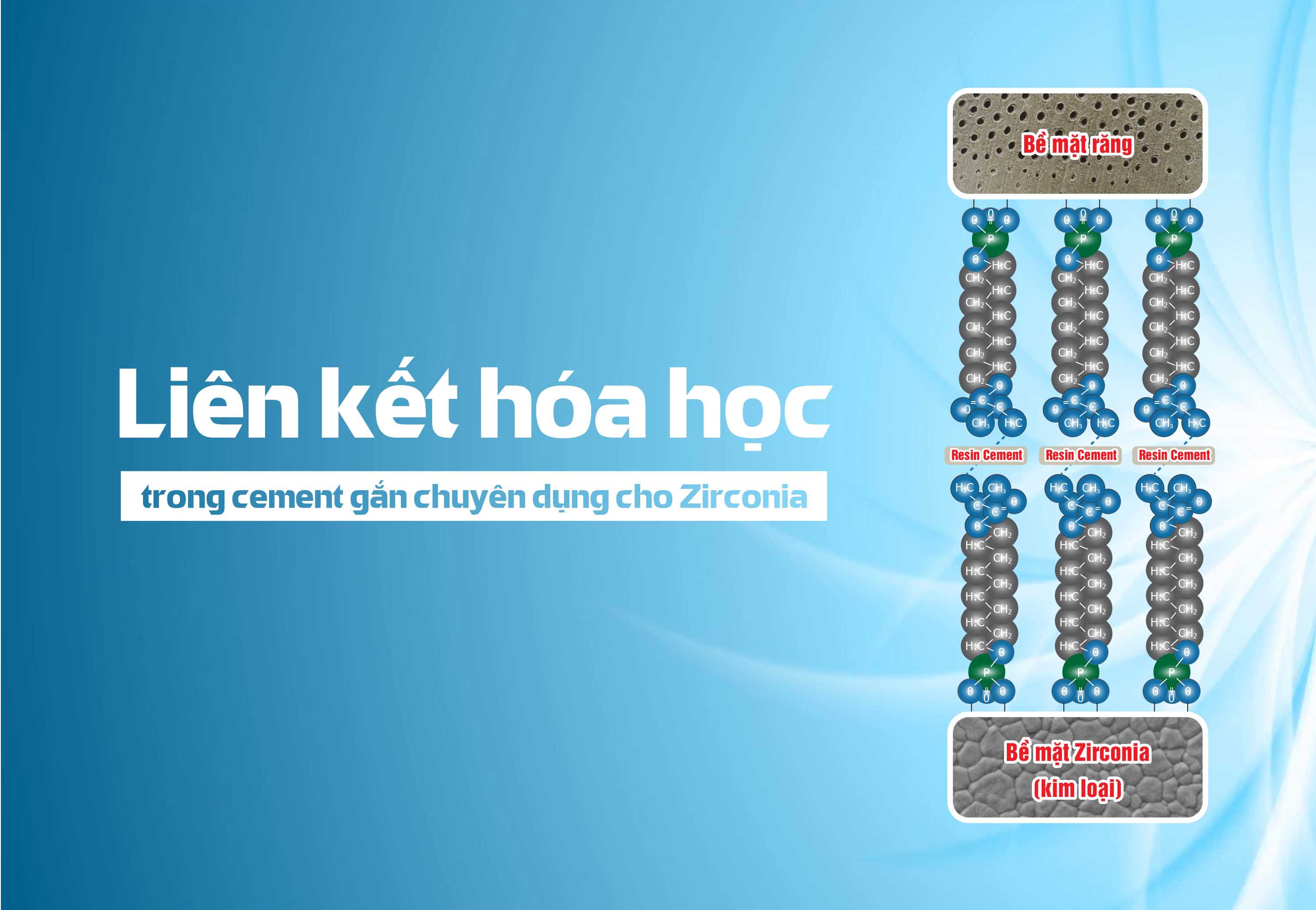 Liên kết hóa học trong cement gắn chuyên dụng cho Zirconia